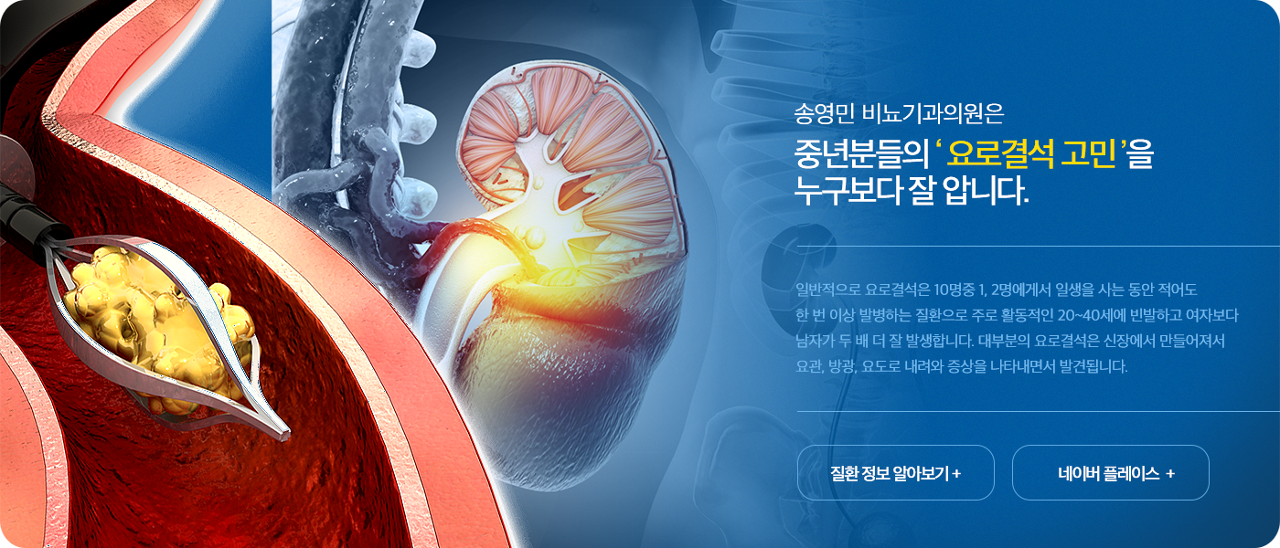 요로결석 고민